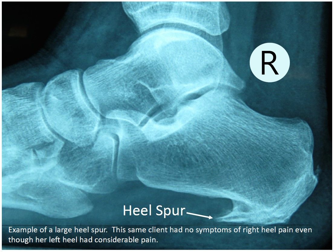 Right Heel Spur on x-ray