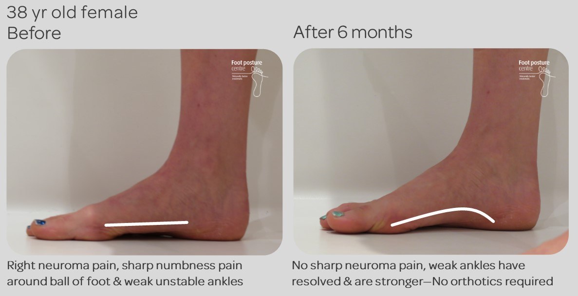 Morton's Neuroma pain resolved non-surgically with no orthotics