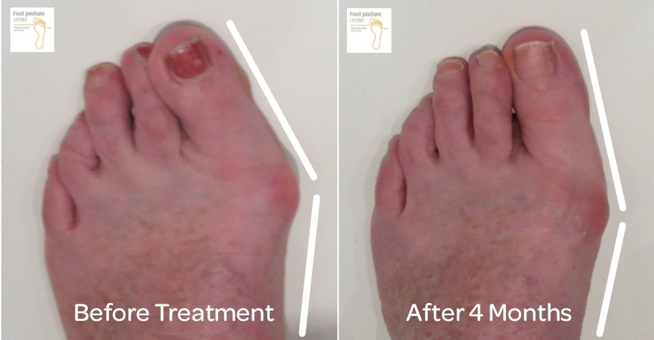 Bunions Natural Treatment