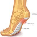 Heel Pain