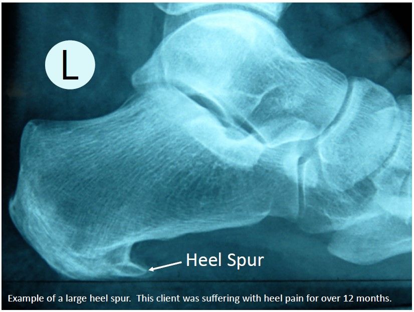 x rays of heel spurs