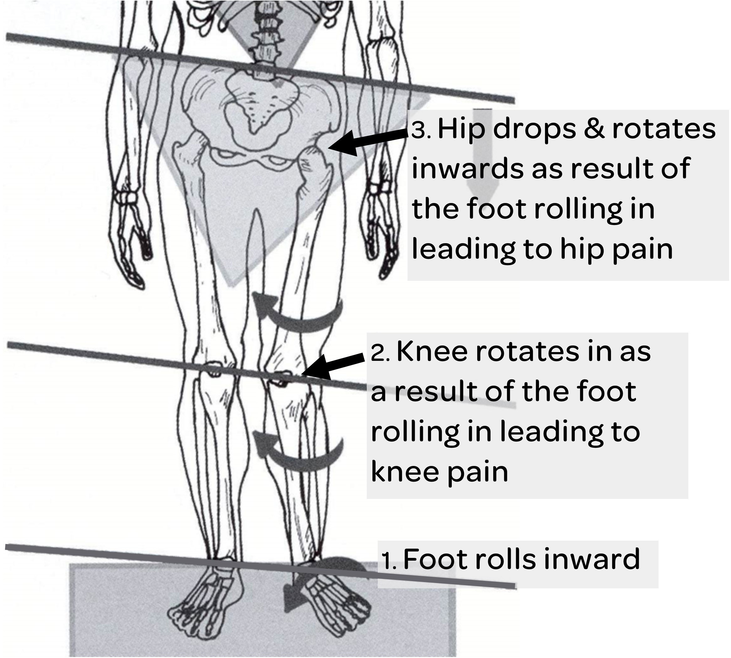 Knee pain can be caused when the foot rolls inwards or pronates. This leads to strain on the knee joint